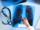 На Кіровоградщині спостерігається зменшення рівня захворюваності на туберкульоз