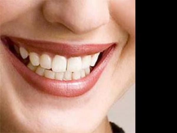 Новина Эстетическое протезирование зубов винирами в клинике «Импладент» Ранкове місто. Кропивницький